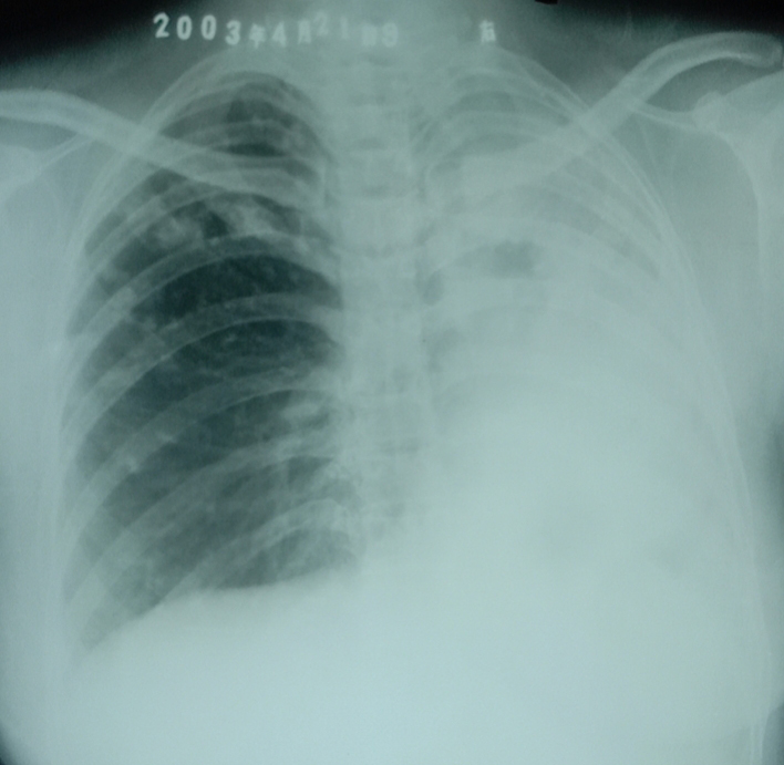 2002年肺结核X光片