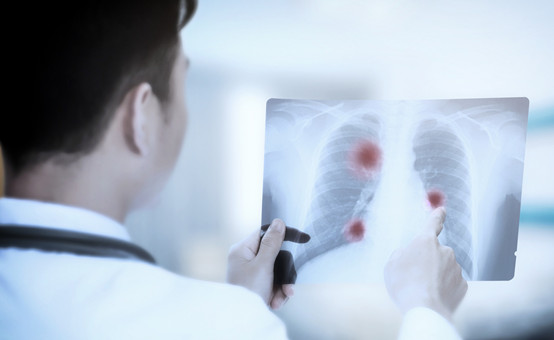 肺结核都有哪些类型，怎么治疗