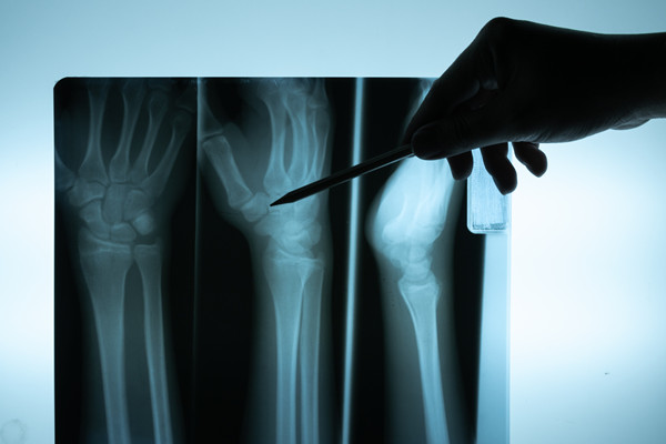 骨结核手术 骨结核手术