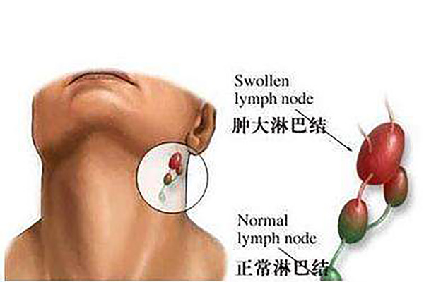 淋巴结核怎么治