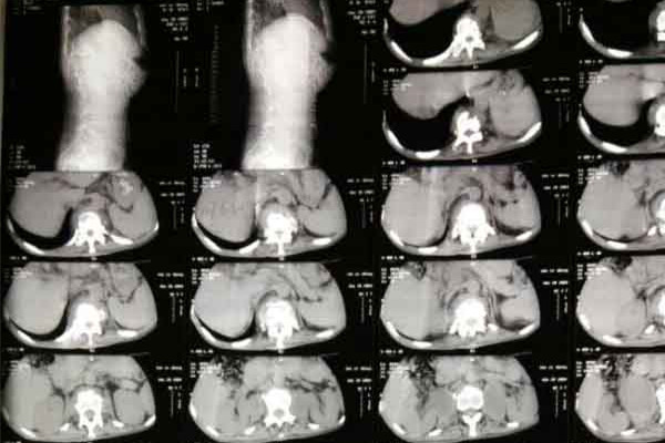 骨结核怎么治疗好 骨结核怎么治疗好