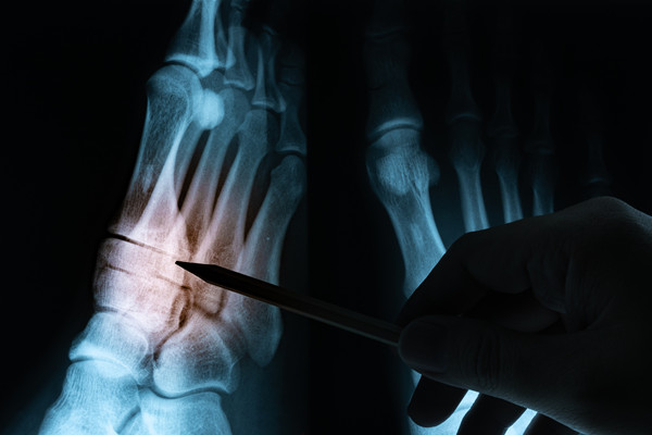 骨结核怎么治疗好 骨结核怎么治疗好