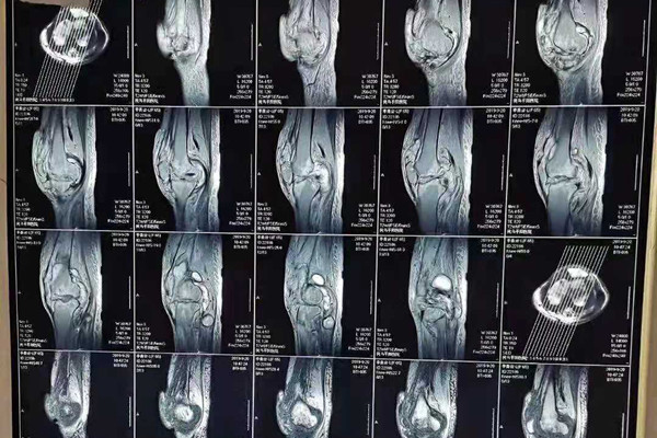 骨结核怎么治疗好 骨结核怎么治疗好